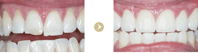 歯の形、先端のライン
