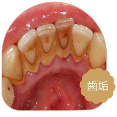 歯垢・プラーク