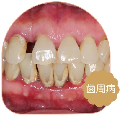 歯周病