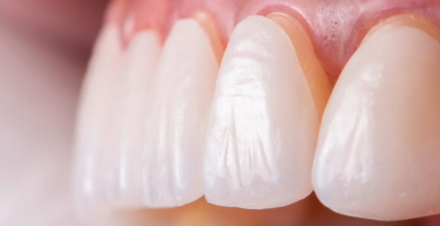 セラミックで整えるきれいで健康な歯