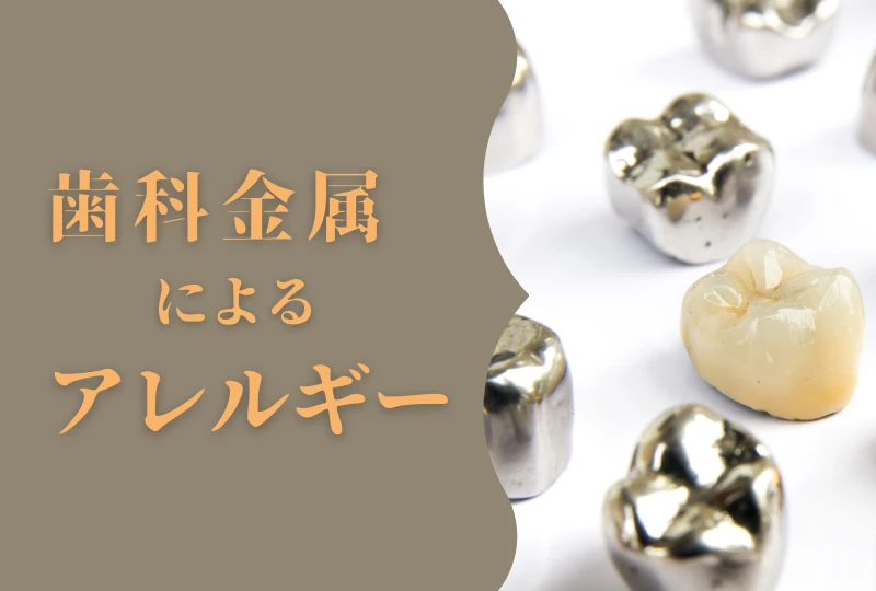 歯科での歯科金属アレルギー治療
